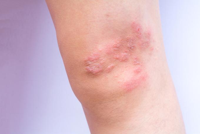 Dermatite du spa : causes et mesures préventives
