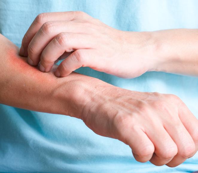 Eczéma des mains, doigts : signes, causes et traitement