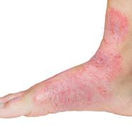 pied atteint de psoriasis